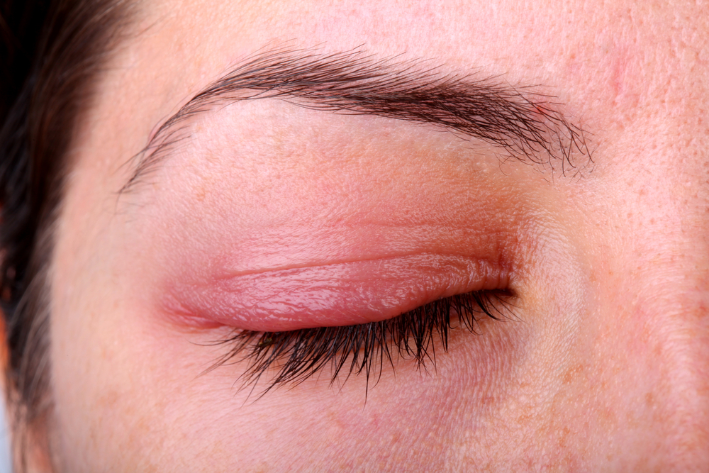 inflamed eyelid